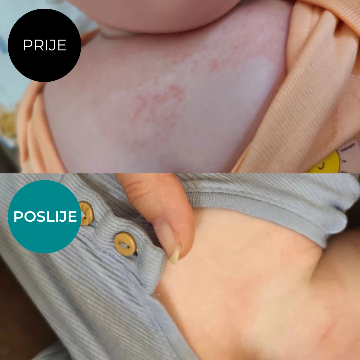 Prije i poslije Balzam Akut