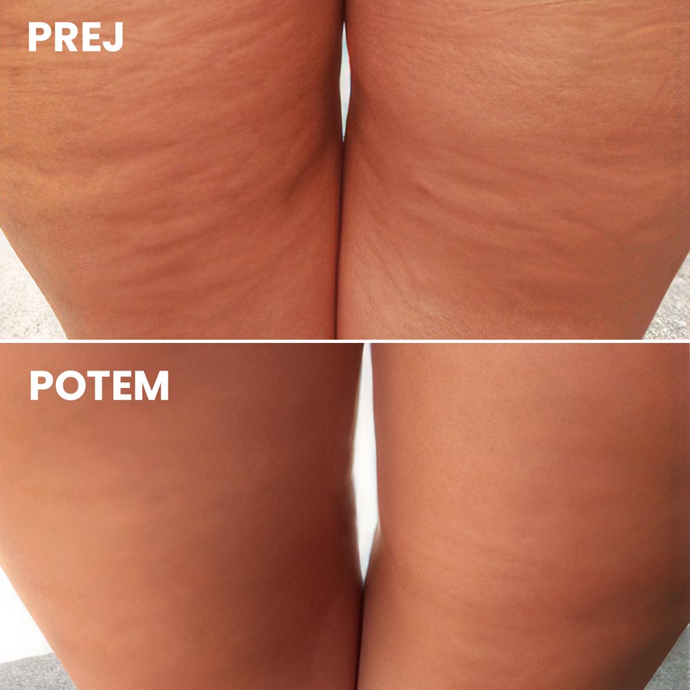 Thermoactive Gel Top Form Against Cellulite