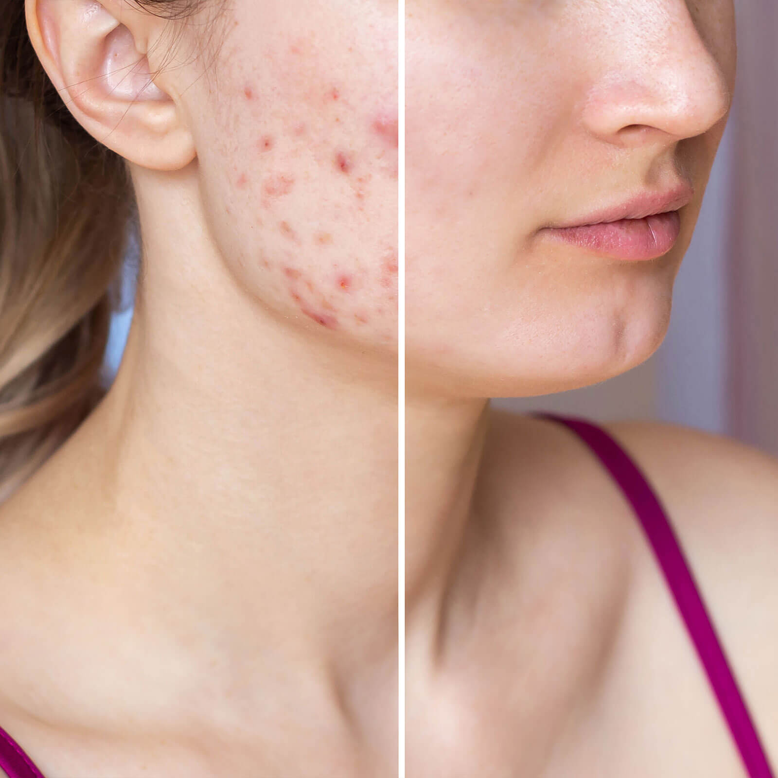 SOS serum for problematic skin, morning care