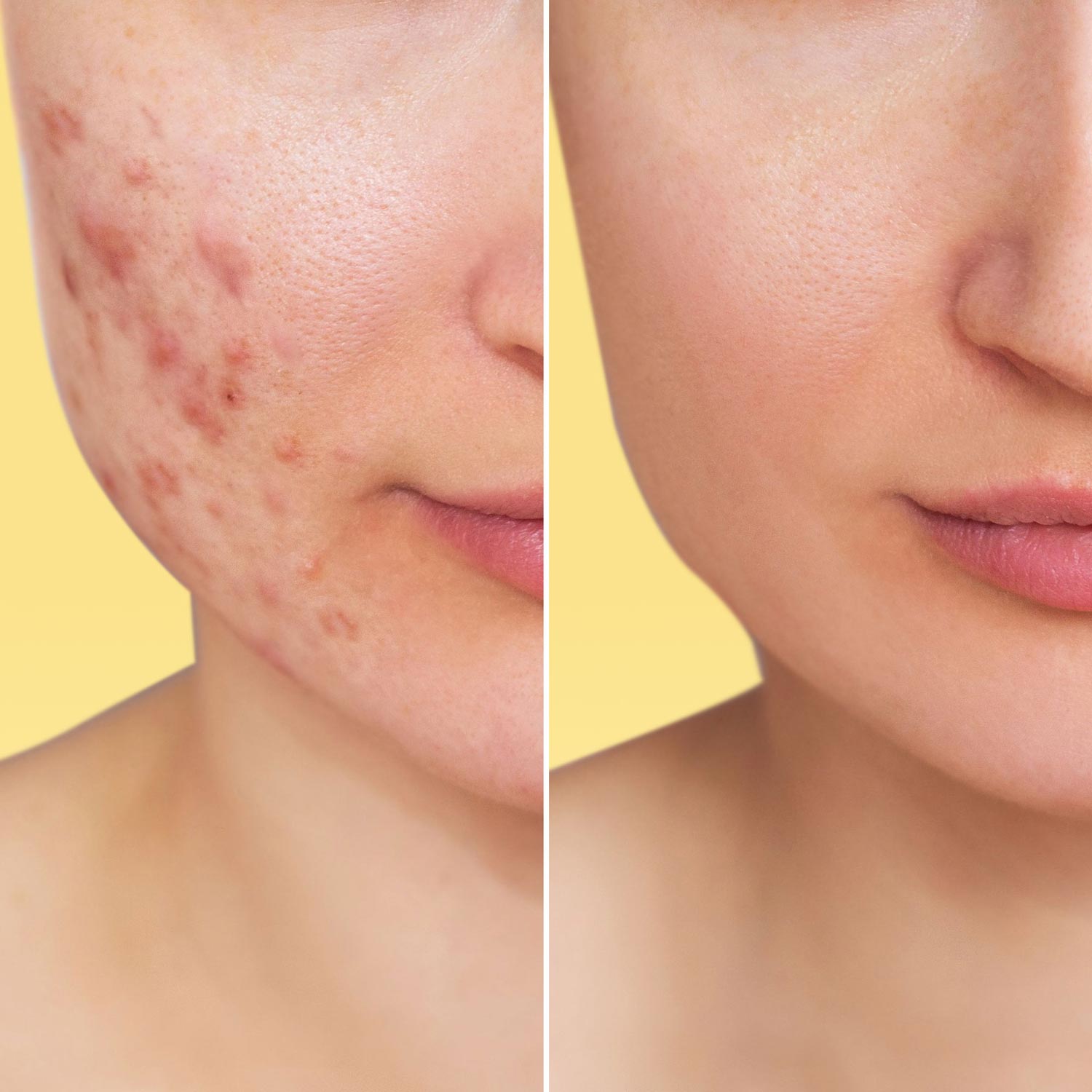 SOS Gel for Acne, Evening Care