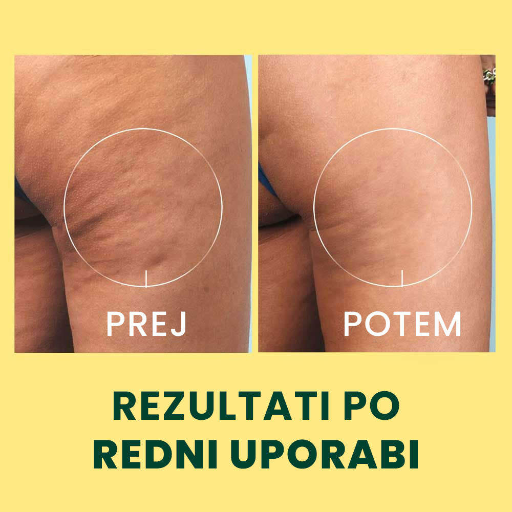 DREN palica proti celulitu