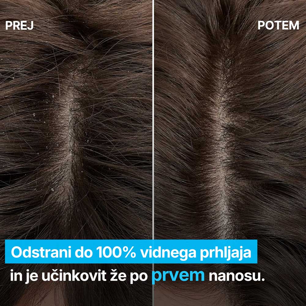 Šampon proti prhljaju