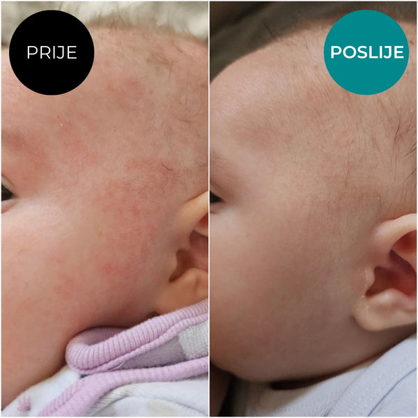 Recenzija prije i poslije - Emulzija za njegu suhe kože i Balzam akut