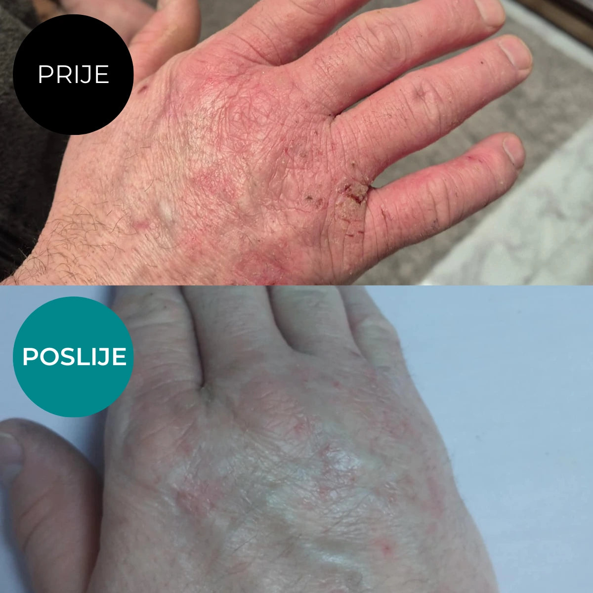 Hand emulsion for the care of very dry skin prone to atopy