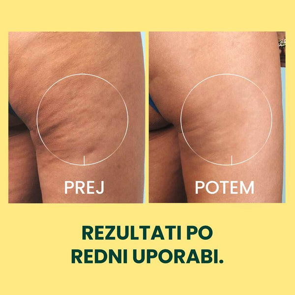 Anti-celulitídový set