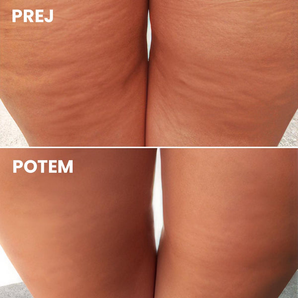 Termoaktivní gel Top Form proti celulitidě